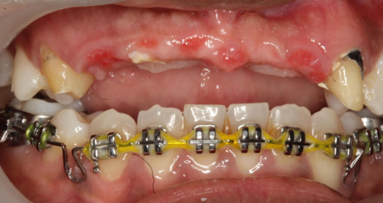 Best Dental implants in Wakad