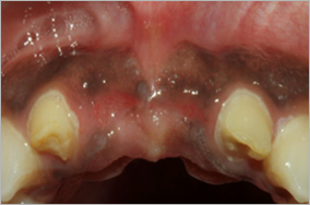 Replacement of 2 front teeth by dental implants