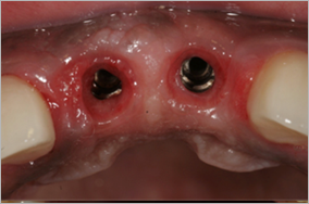 Replacement of 2 front teeth by dental implants