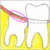 Tissue Impaction