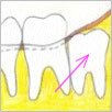 Impacted wisdom tooth