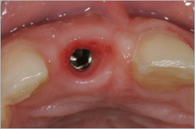 Teeth replaced by dental implants – replacement of a front tooth